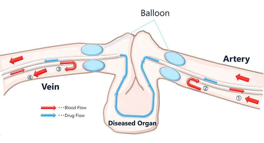 Concept image of organ perfusion using special catheters with balloons