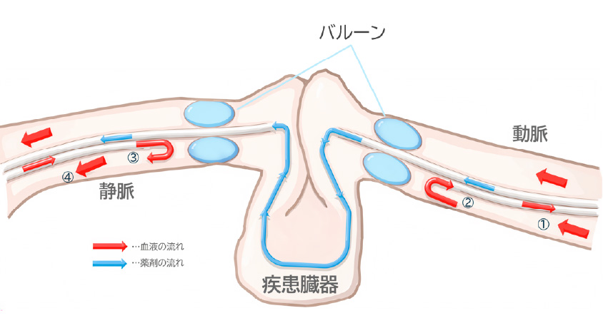 特殊なバルーンカテーテルを使った臓器灌流のイメージ