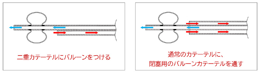 特殊なバルーンカテーテルの実例